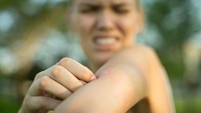 Mosquito Bite Remedies